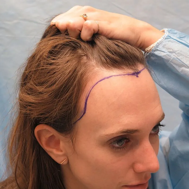 Hair Transplant UK – Permanent Results for Hair Loss